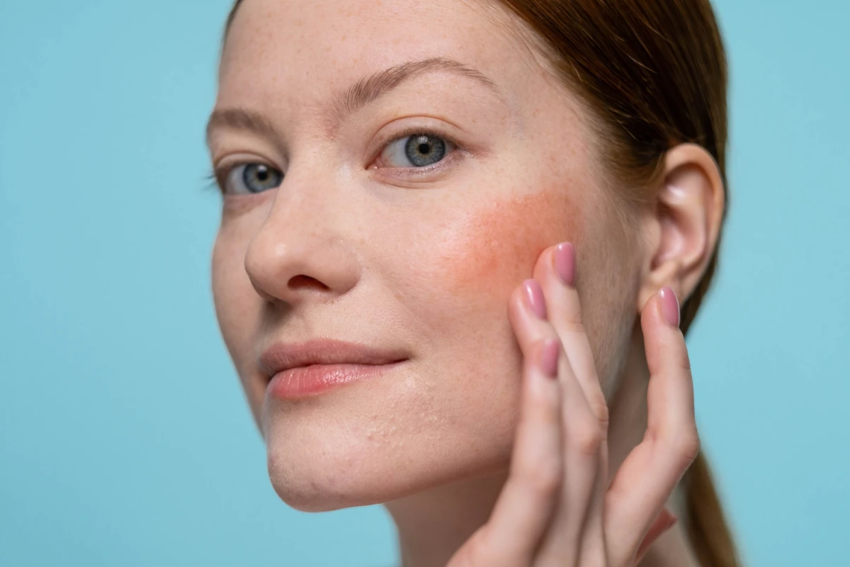 Rosacea Yolanda Ugarte